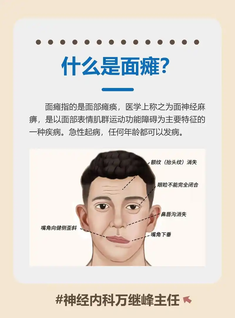 面瘫指的是面部瘫痪,医学上称之为面神经麻痹,是以面部表情肌群运动